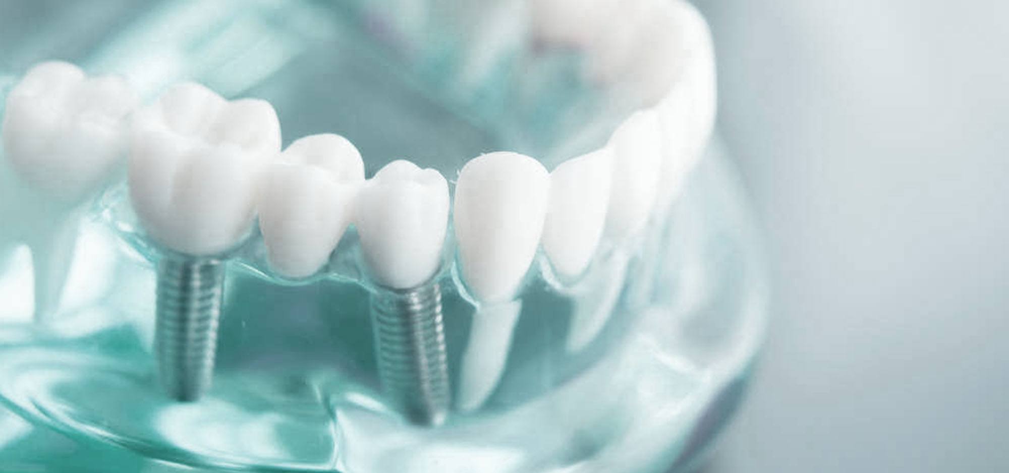 TIPOS DE IMPLANTES DENTALES Todo Lo Que Necesitas Saber Clinica Dental Gonzalez Orta