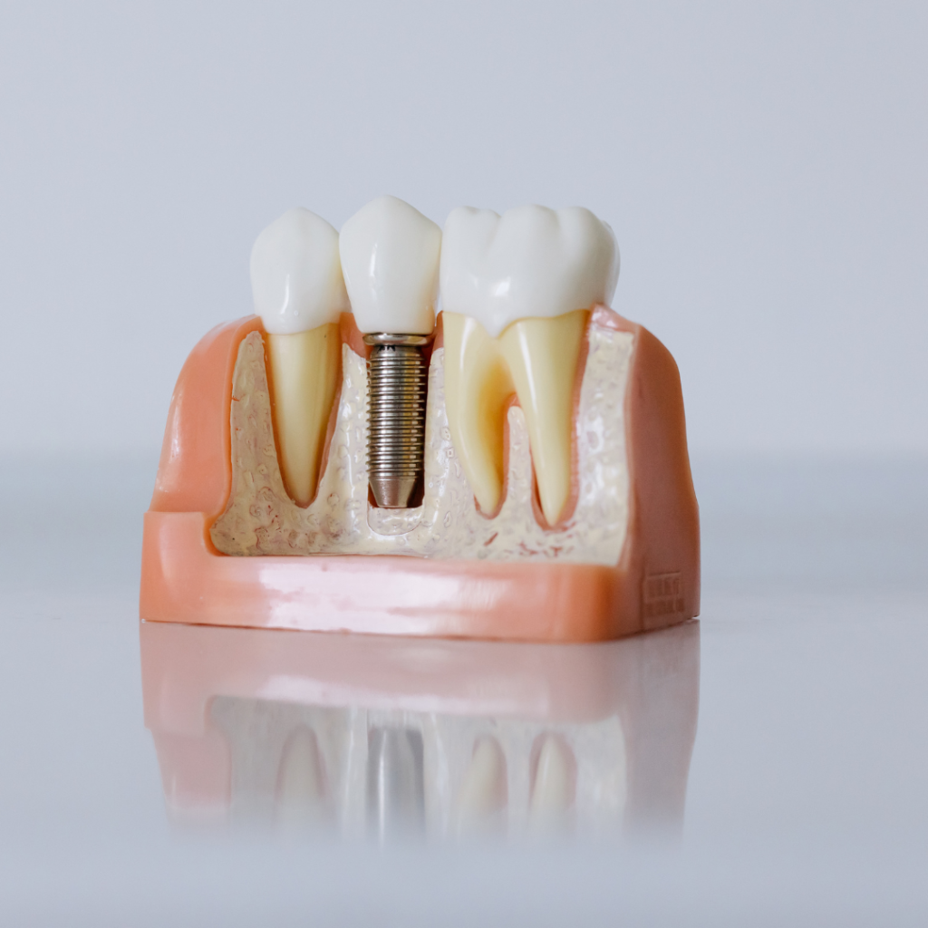 Sonríe con Confianza: Conoce los Diferentes Tipos de Implantes Dentales