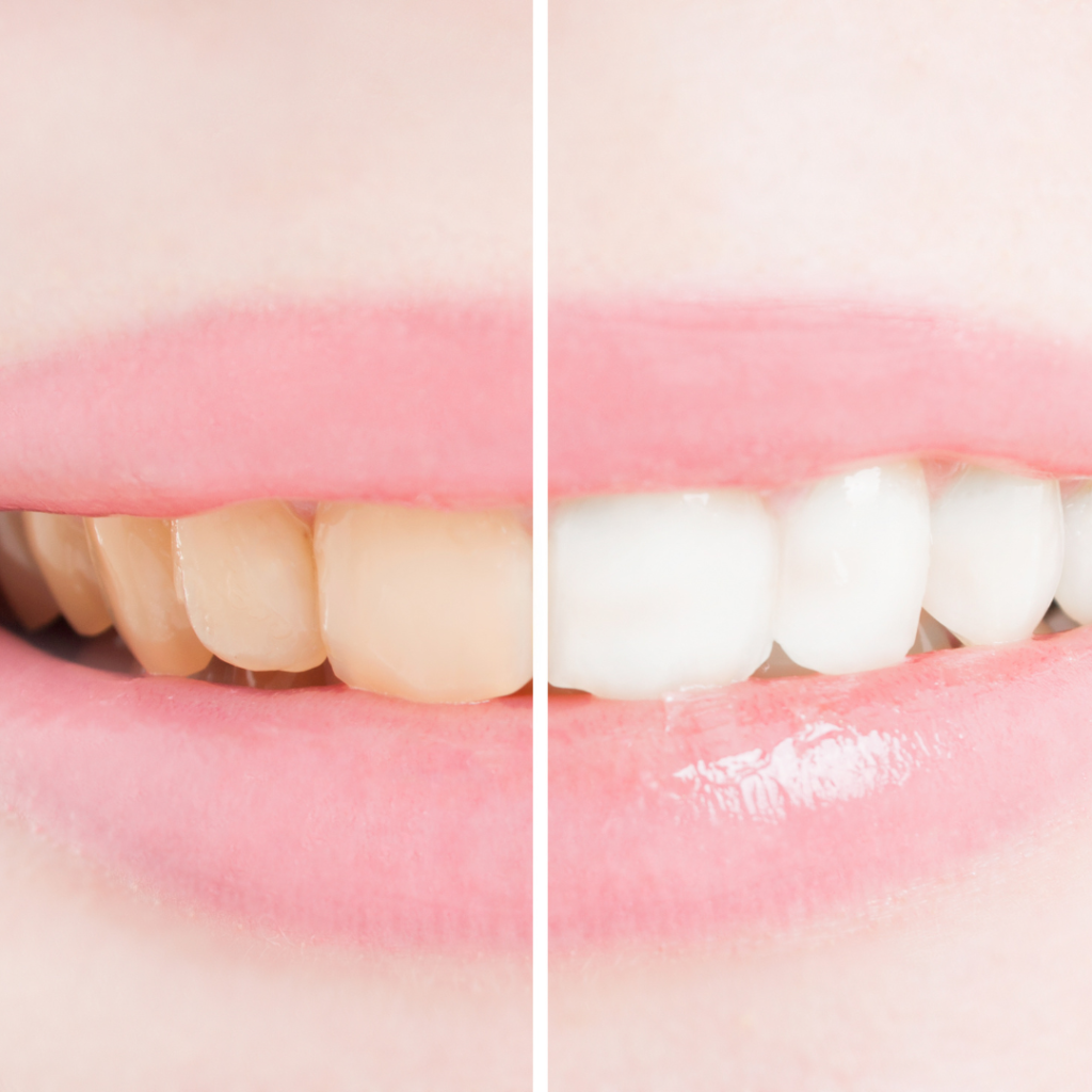 Sonrisa Deslumbrante y Más Allá: Descubre los Beneficios del Blanqueador Dental