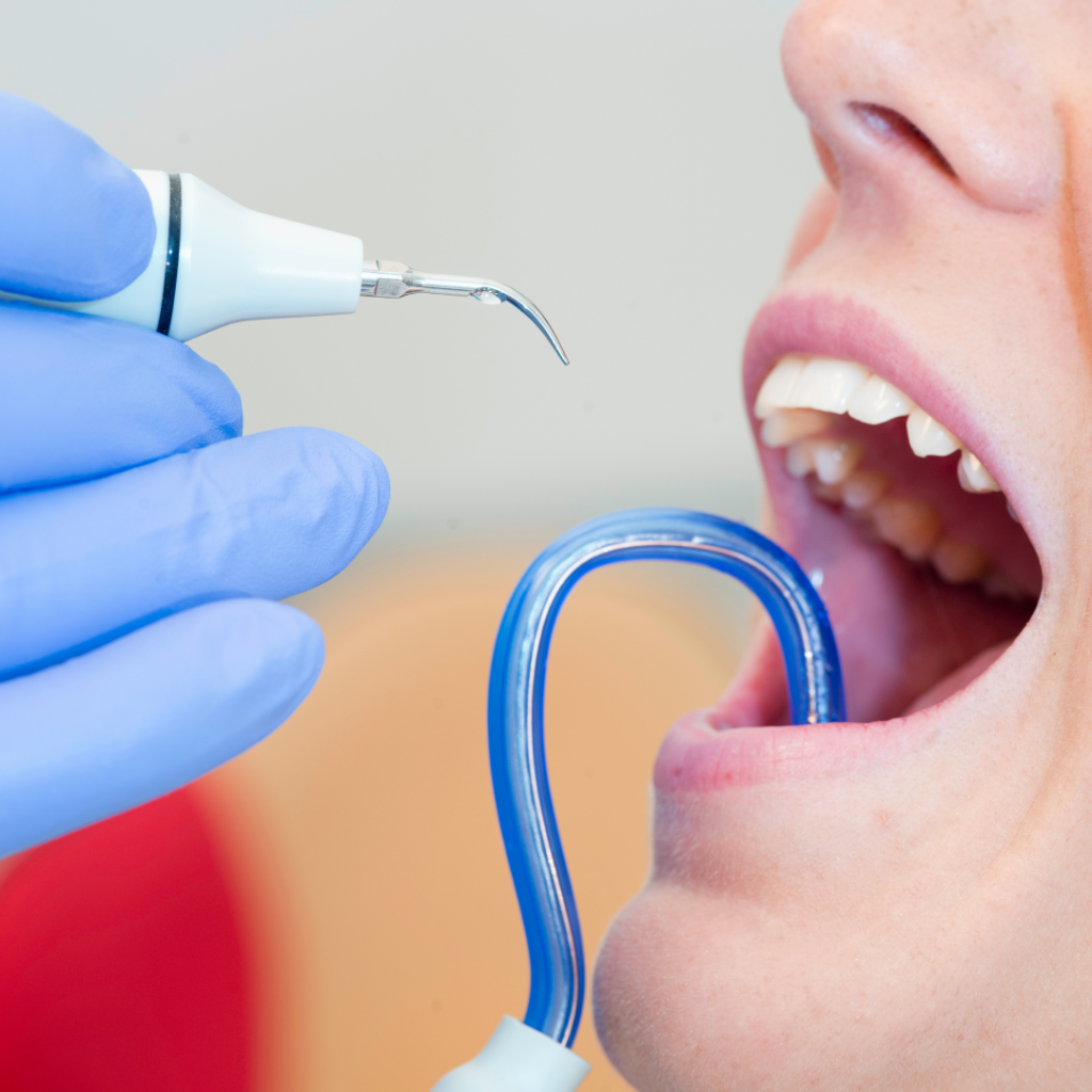 Sarro Dental: Lo que Debes Saber y Cómo Prevenirlo